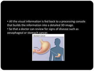 • All the visual information is fed back to a processing console
that builds the information into a detailed 3D image.
• So that a doctor can review for signs of disease such as
oesophageal or stomach cancer.
 