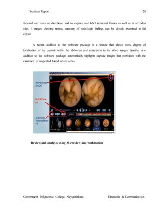Seminar Report 28
Government Polytechnic College, Neyyattinkara Electronic & Communication
forward and rever se directions, and to capture and label individual frames as well as br ief video
clips. I mages showing normal anatomy of pathologic findings can be closely examined in full
colour.
A recent addition to the software package is a feature that allows some degree of
localisation of the capsule within the abdomen and correlation to the video images. Another new
addition to the software package automatically highlights capsule images that correlates with the
existence of suspected blood or red areas.
Review and analysis using Microview and workstation
 