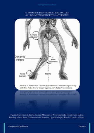 www.sportscienzasalute.it
Competenza Qualificata Pagina 6
E’ POSSIBILE PREVENIRE GLI INFORTUNI
AL LEGAMENTO CROCIATO ANTERIORE?
Figura 2Hewett et al. Biomechanical Measures of Neuromuscular Control and Valgus
Loading of the Knee Predict Anterior Cruciate Ligament Injury Risk in Female Athletes.
 