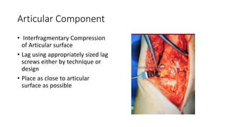 Pilon Column Ankle Fracture :Pilon Map Column Concept | PPTX