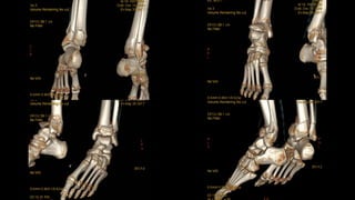 Pilon Column Ankle Fracture :Pilon Map Column Concept | PPTX