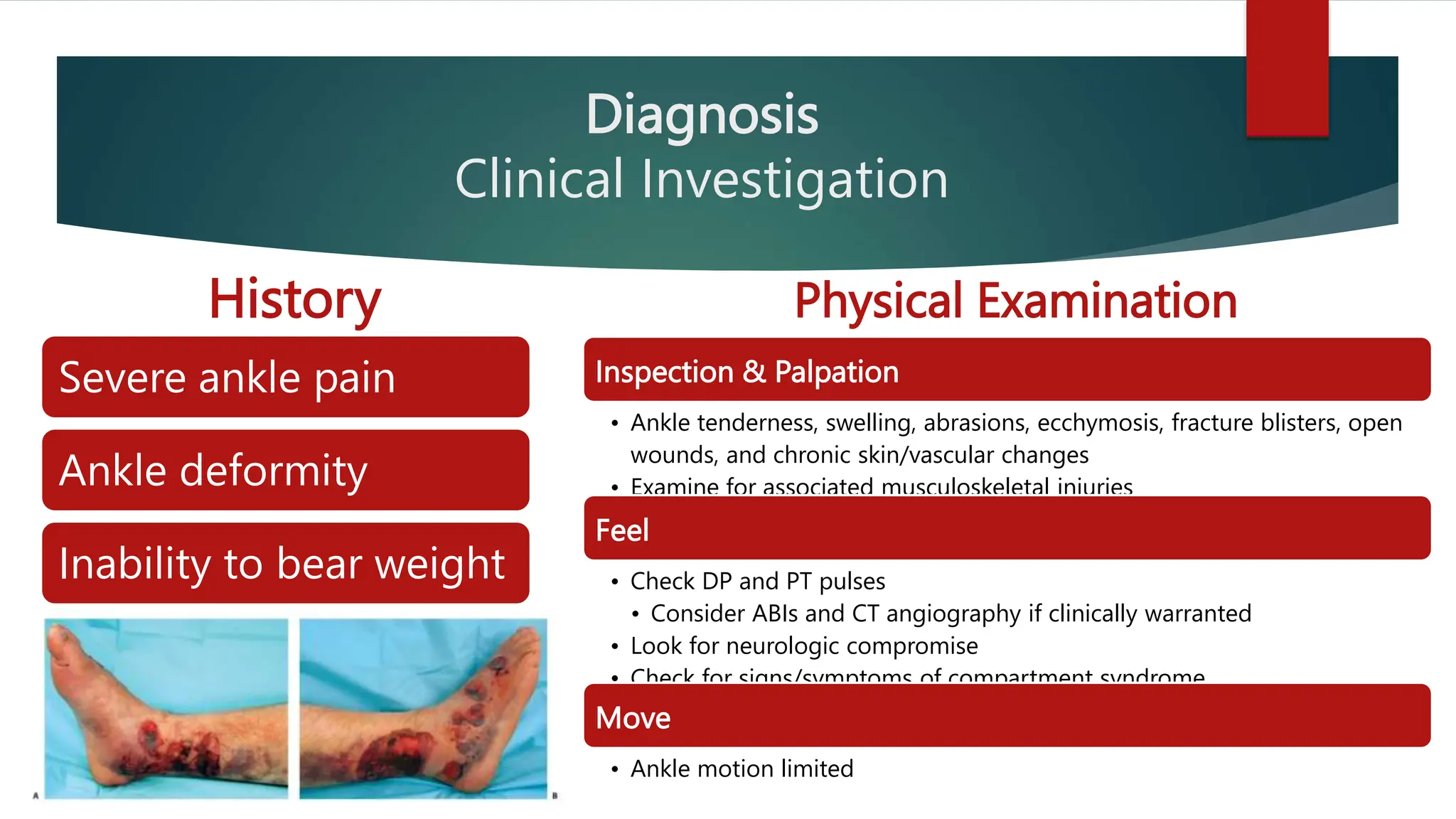 Diagnosis and Management of Tibial Plafond / Pilon Fracture.pptx