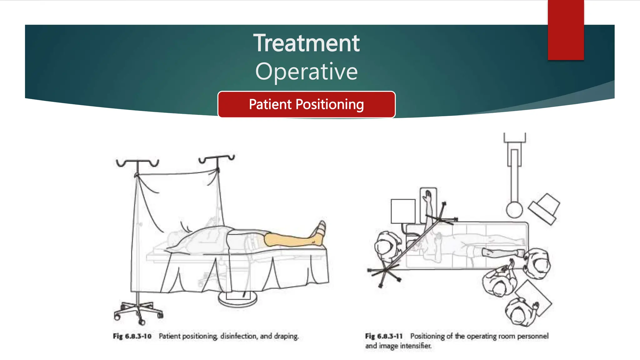 Diagnosis and Management of Tibial Plafond / Pilon Fracture.pptx