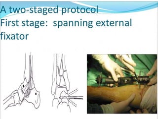 Pilon fracture | PPTX