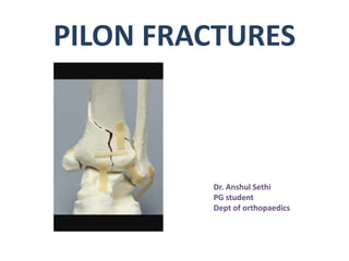PILON FRACTURES
Dr. Anshul Sethi
PG student
Dept of orthopaedics
 