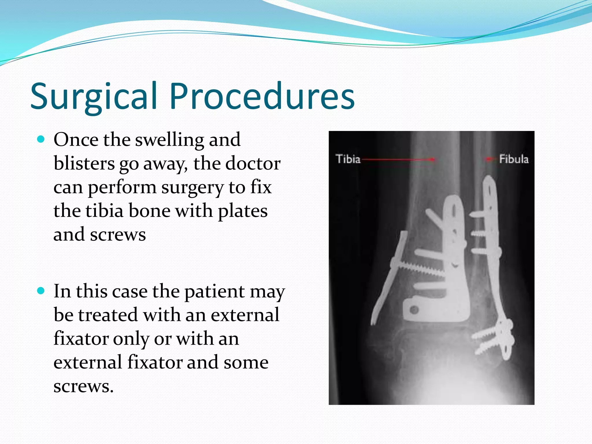 Risk Factors	Age. The average age of someone with a pilon fracture is 35 to 40 years old. Pilon fractures are rare in children and elderly people. However, as our population ages, seniors will account for a larger amount of these fractures. 	Male. Men are three times more likely than women to have pilon fracturesA pilon fracture often affects both bones of the lower leg. 