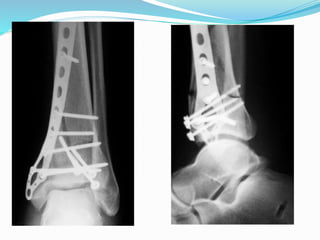 Neuro Pilon Pilon fractures | PPTX