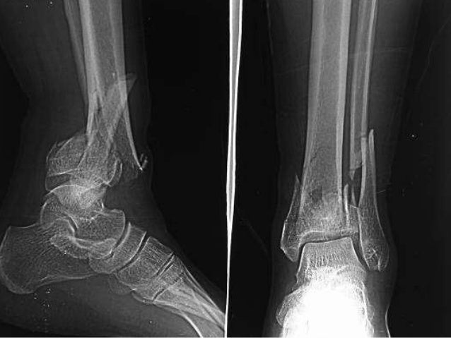 Pilon Fractures