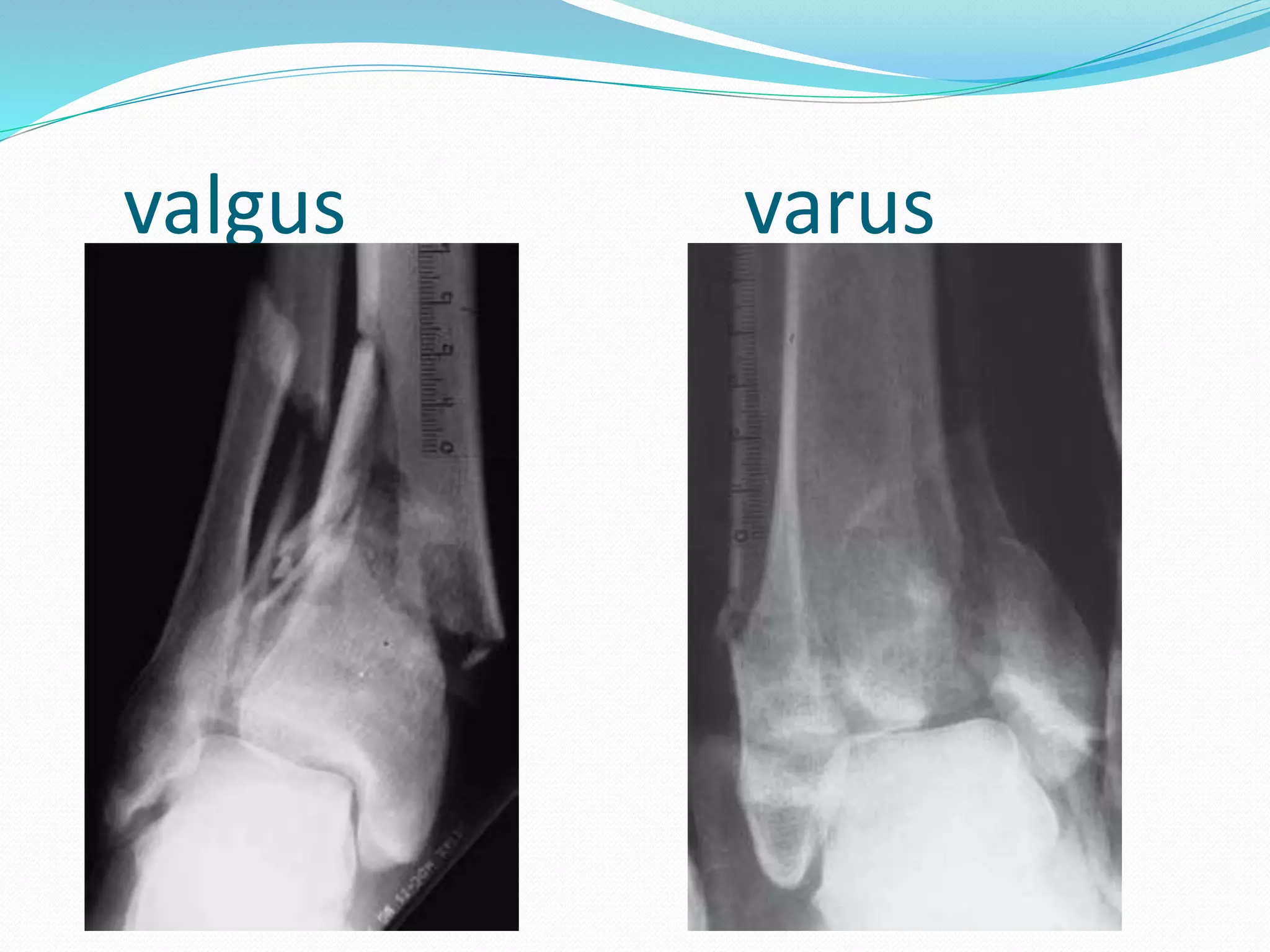 valgus varus
 