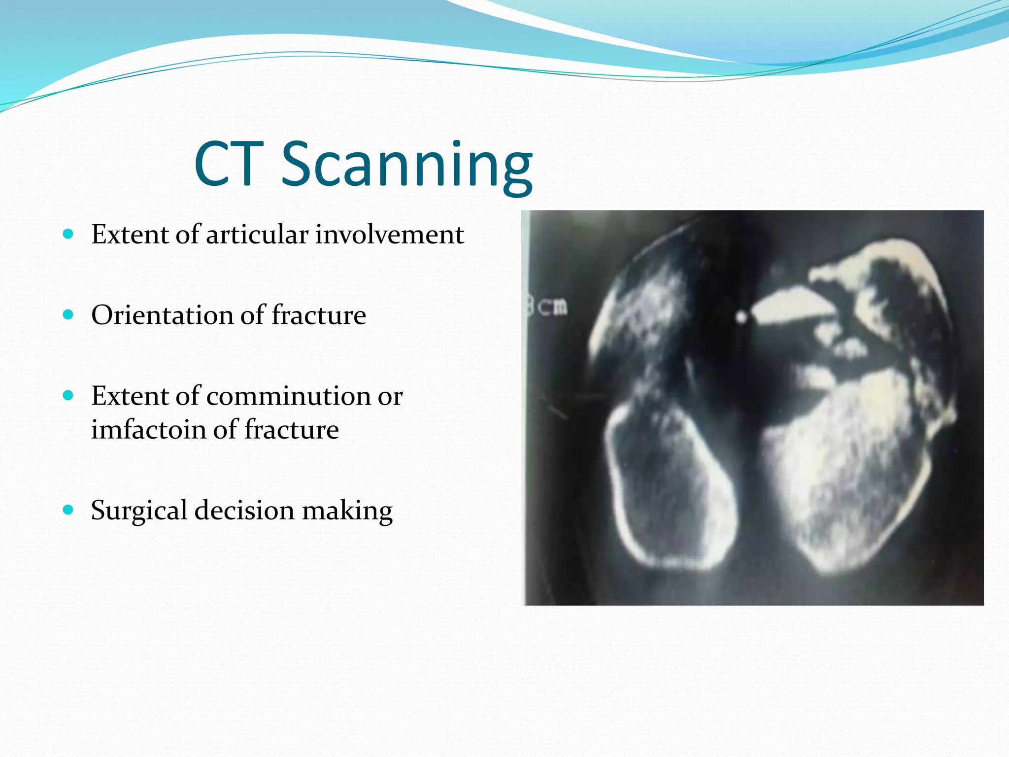 CT Scanning
 Extent of articular involvement
 Orientation of fracture
 Extent of comminution or
imfactoin of fracture
 Surgical decision making
 