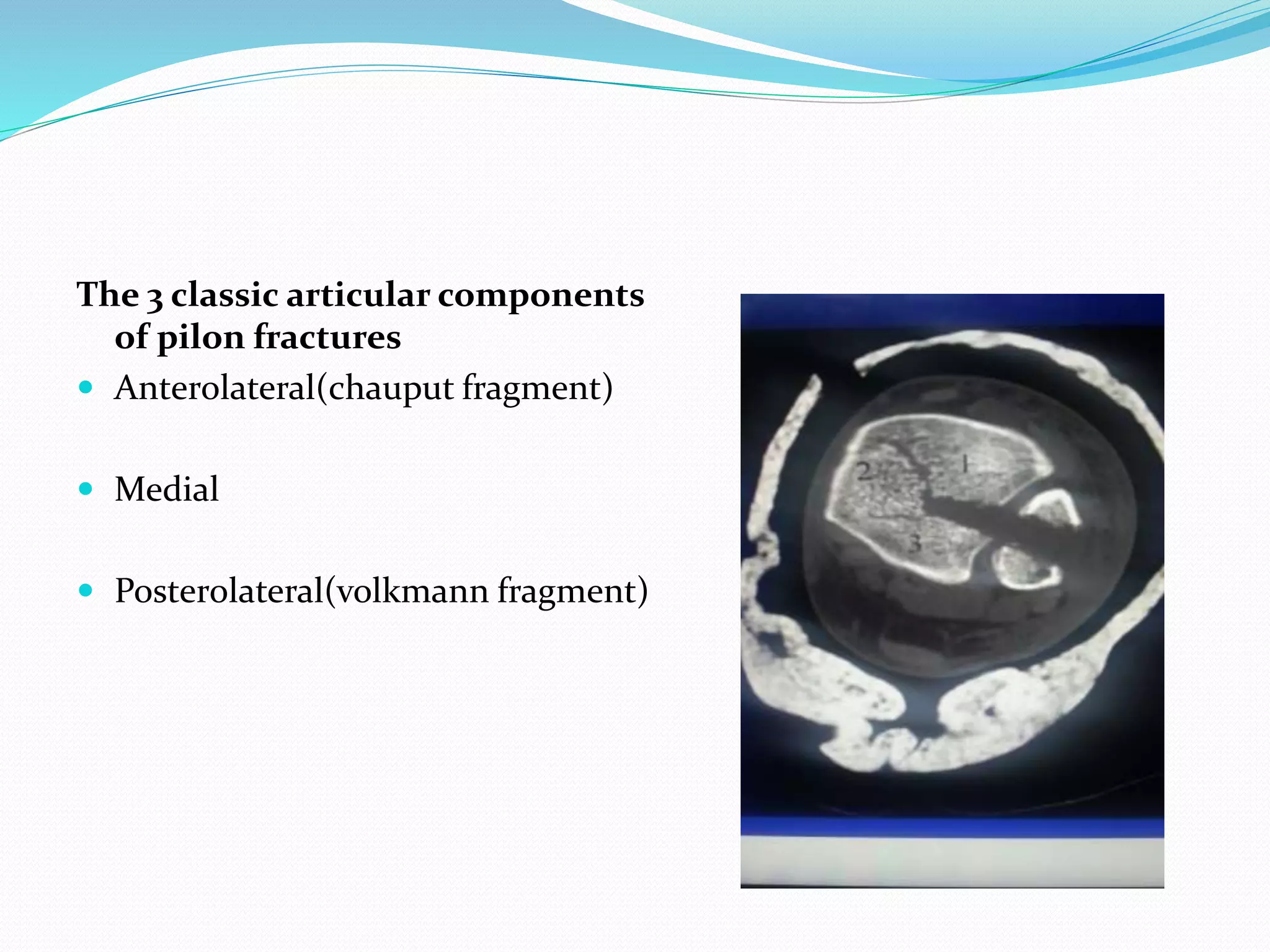 The 3 classic articular components
of pilon fractures
 Anterolateral(chauput fragment)
 Medial
 Posterolateral(volkmann fragment)
 