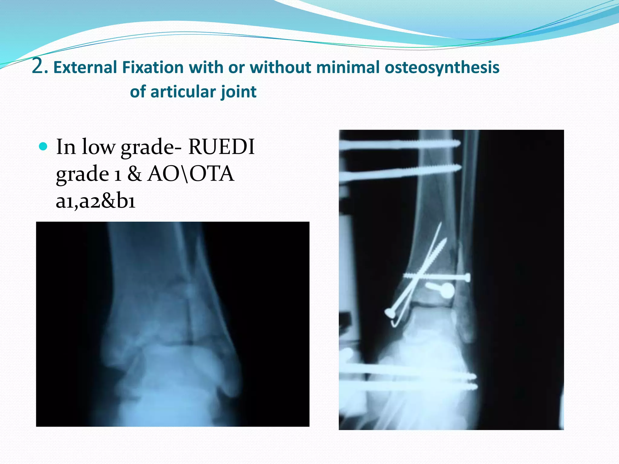 2. External Fixation with or without minimal osteosynthesis
of articular joint
 In low grade- RUEDI
grade 1 & AOOTA
a1,a2&b1
 