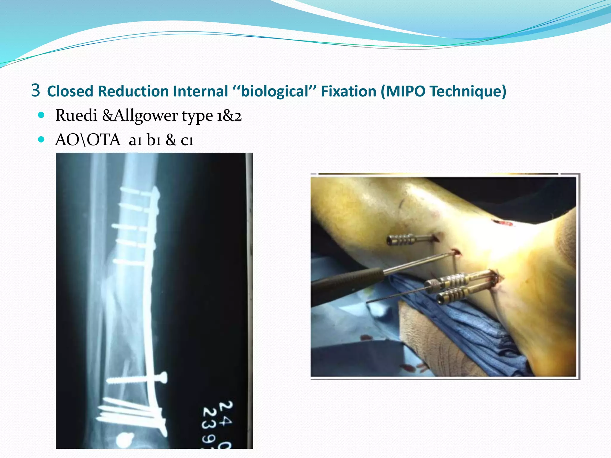 3 Closed Reduction Internal ‘‘biological’’ Fixation (MIPO Technique)
 Ruedi &Allgower type 1&2
 AOOTA a1 b1 & c1
 