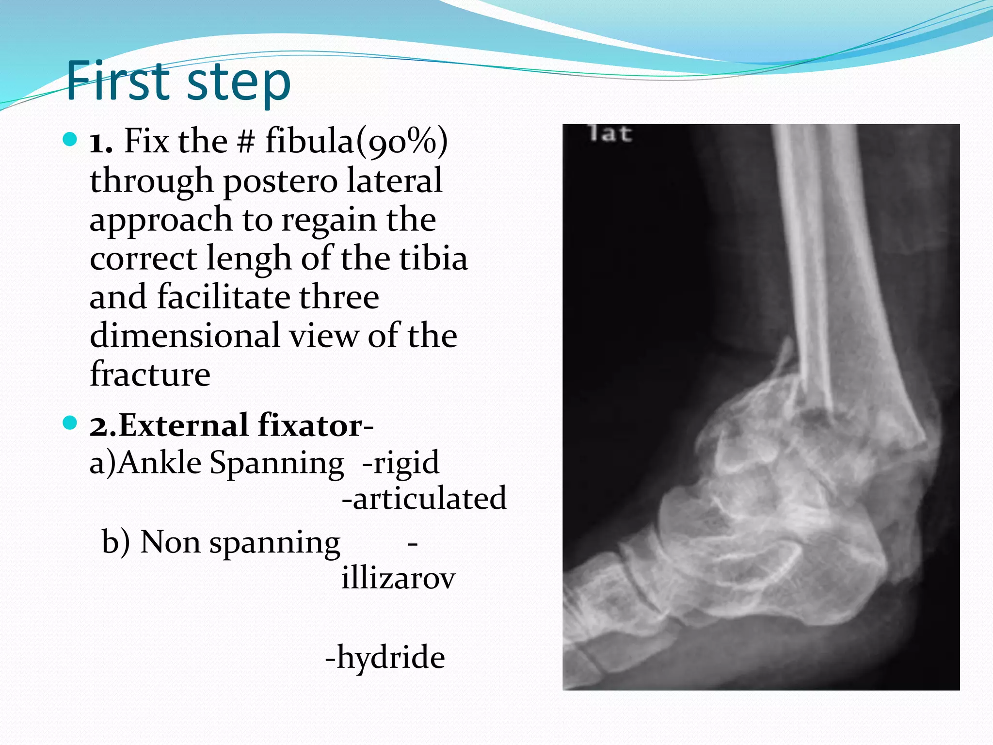  1. Fix the # fibula(90%)
through postero lateral
approach to regain the
correct lengh of the tibia
and facilitate three
dimensional view of the
fracture
 2.External fixator-
a)Ankle Spanning -rigid
-articulated
b) Non spanning -
illizarov
-hydride
First step
 