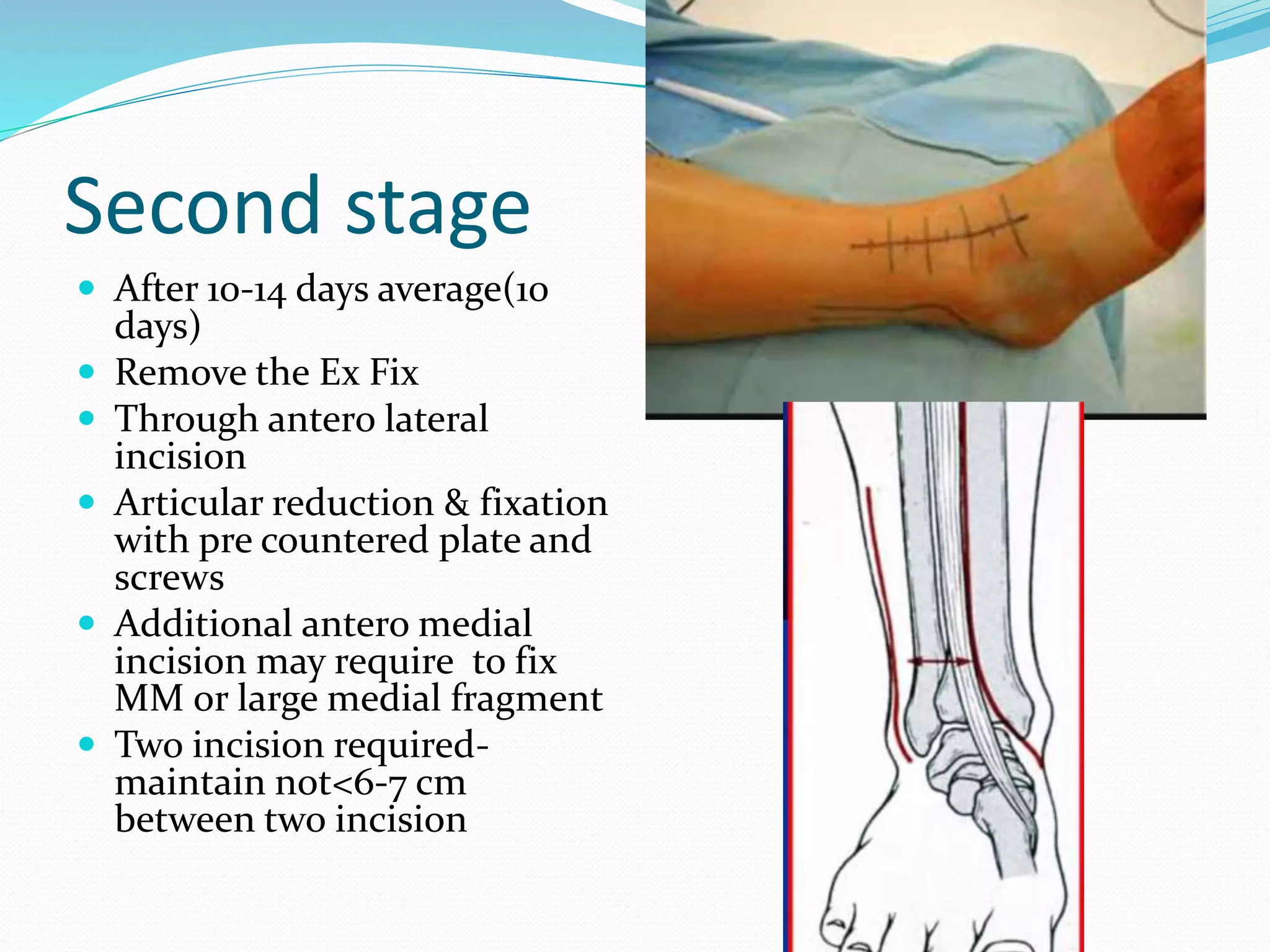 Second stage
 After 10-14 days average(10
days)
 Remove the Ex Fix
 Through antero lateral
incision
 Articular reduction & fixation
with pre countered plate and
screws
 Additional antero medial
incision may require to fix
MM or large medial fragment
 Two incision required-
maintain not<6-7 cm
between two incision
 