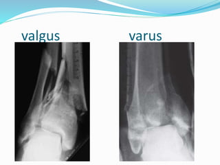 valgus varus
 