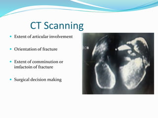 CT Scanning
 Extent of articular involvement
 Orientation of fracture
 Extent of comminution or
imfactoin of fracture
 Surgical decision making
 