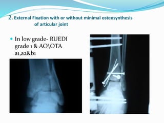 2. External Fixation with or without minimal osteosynthesis
of articular joint
 In low grade- RUEDI
grade 1 & AOOTA
a1,a2&b1
 