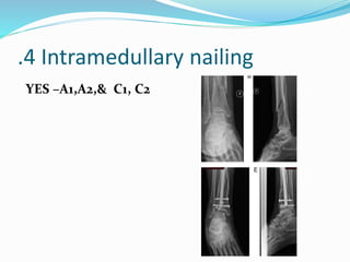 .4 Intramedullary nailing
YES –A1,A2,& C1, C2
 