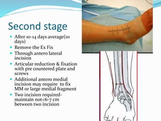 Second stage
 After 10-14 days average(10
days)
 Remove the Ex Fix
 Through antero lateral
incision
 Articular reduction & fixation
with pre countered plate and
screws
 Additional antero medial
incision may require to fix
MM or large medial fragment
 Two incision required-
maintain not<6-7 cm
between two incision
 