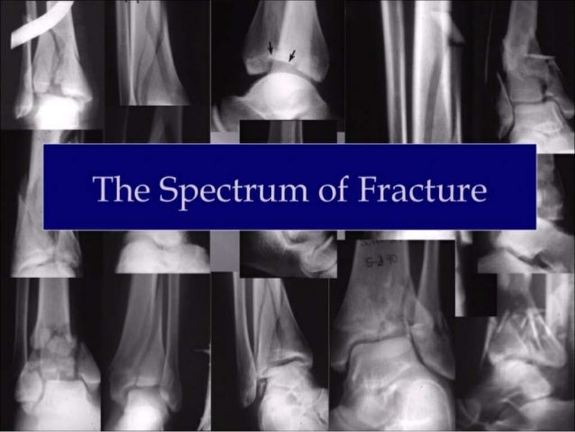 Pilon fractures
