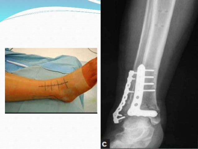 pilon fracture recovery blog pilon fracture recovery blog