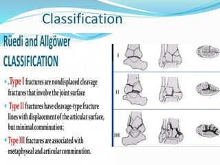 Pilon fractures | PPTX