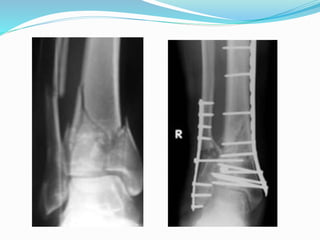 Pilon fractures | PPTX