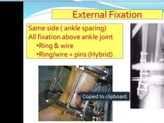 Pilon fractures | PPTX