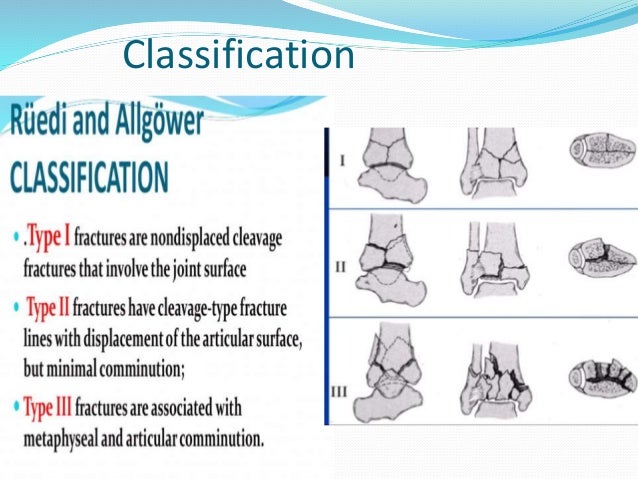 Pilon Fracture Classification , Evolution in Management of Tibial Pilon ...