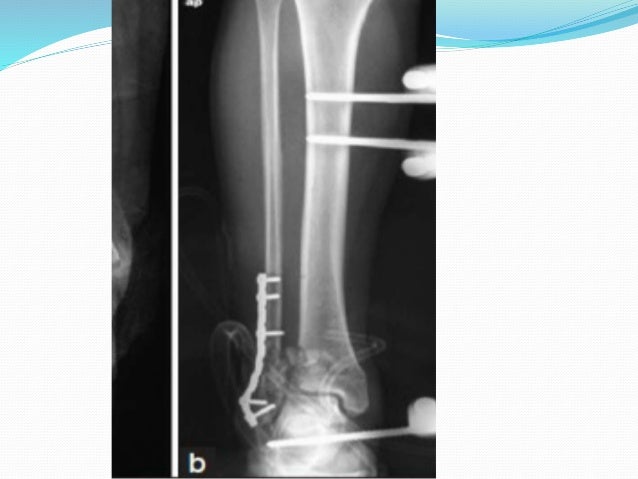 pilon fracture recovery blog pilon fracture recovery blog