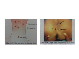 Pilonidal Disease | PPTX
