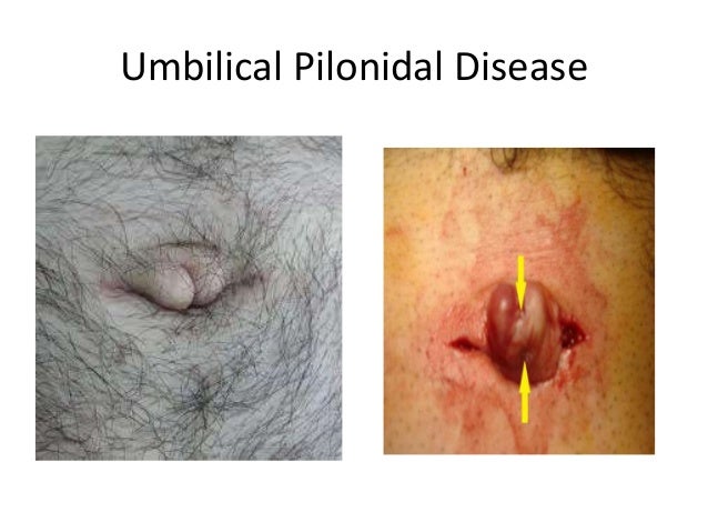 Anorectal Disease: Pilonidal Disease - ncbi.nlm.nih.gov