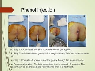 Phenol Injection
a. Step 1: Local anesthetic (2% lidocaine solution) is applied.
b. Step 2: Hair is removed gently with a surgical clamp from the pilonidal sinus
pit.
c. Step 3: Crystallized phenol is applied gently through the sinus opening.
d. Postoperative view. The total procedure time is around 10 minutes. The
patient can be discharged and return home after the treatment.
 