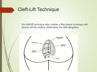 the cleft-lift technique also creates a flap-based coverage with
closure off the midline, obliterating the cleft altogether
Cleft-Lift Technique
 