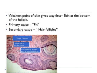  Weakest point of skin gives way first– Skin at the bottom
of the follicle.
 Primary cause – “Pit”
 Secondary casue – “ Hair follicles”
 