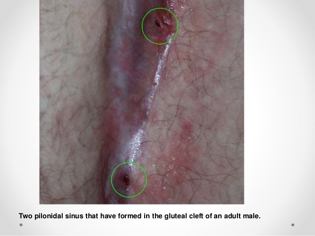 After pilonidal & before pictures cyst After pilonidal & before pictures cyst