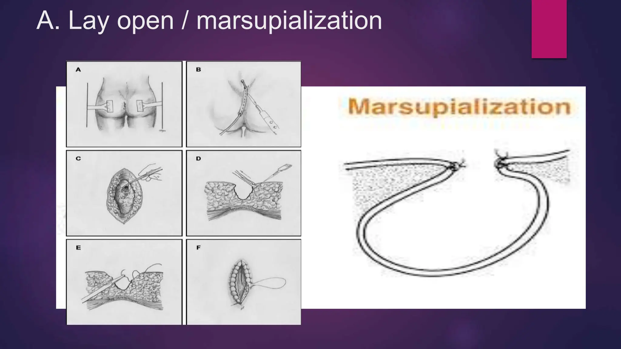 A. Lay open / marsupialization
 