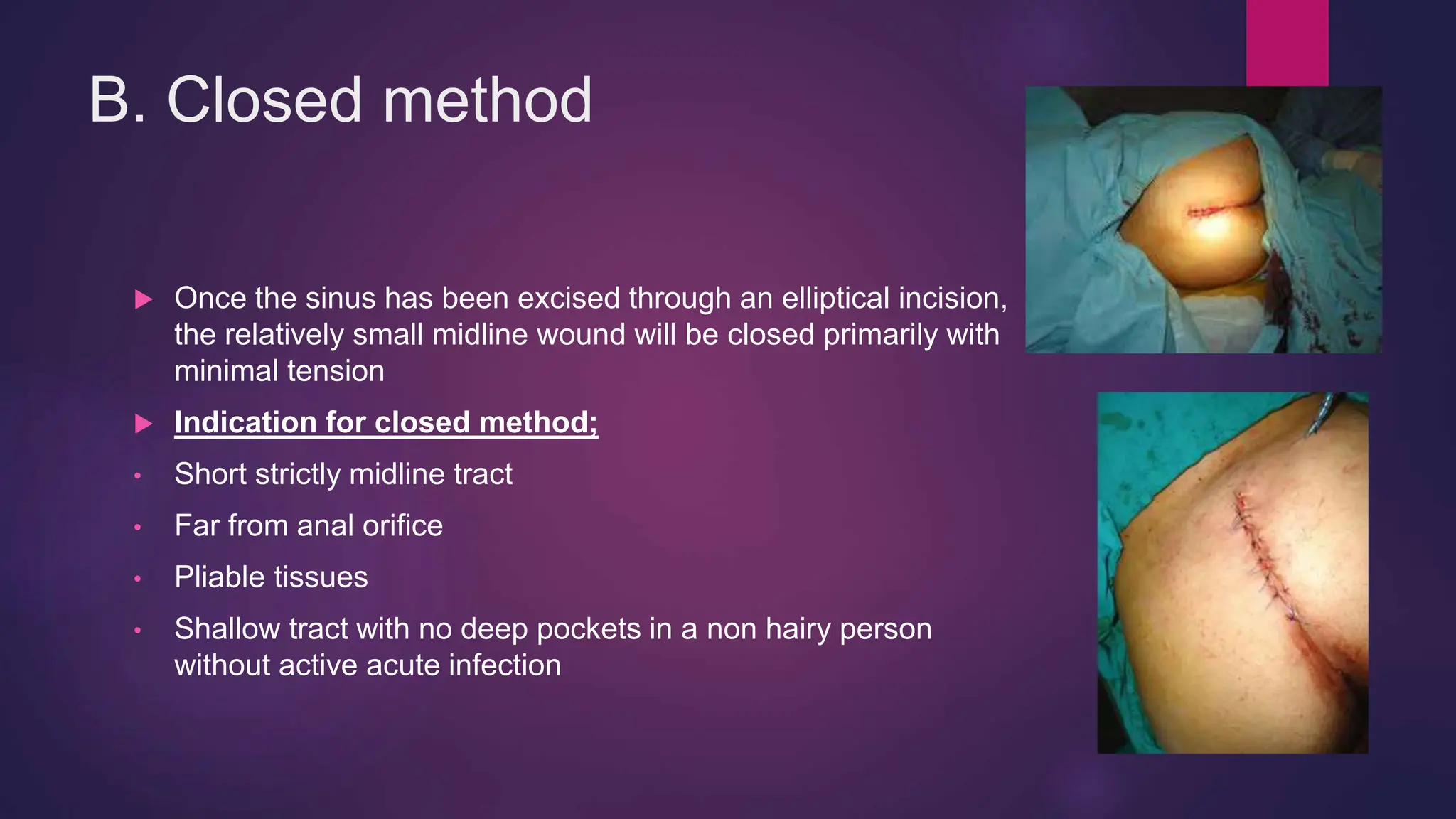 B. Closed method
 Once the sinus has been excised through an elliptical incision,
the relatively small midline wound will be closed primarily with
minimal tension
 Indication for closed method;
• Short strictly midline tract
• Far from anal orifice
• Pliable tissues
• Shallow tract with no deep pockets in a non hairy person
without active acute infection
 