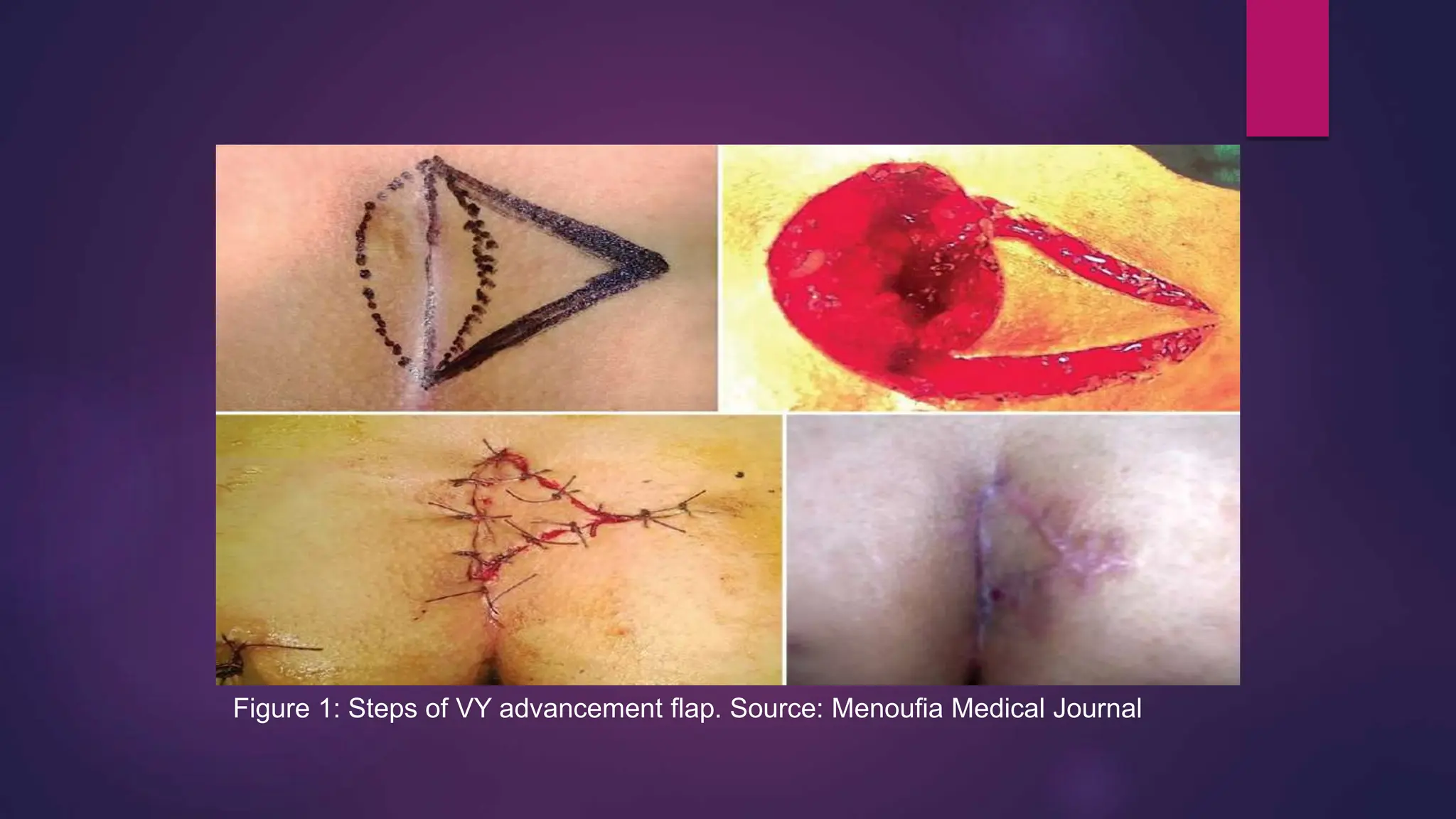 Figure 1: Steps of VY advancement flap. Source: Menoufia Medical Journal
 