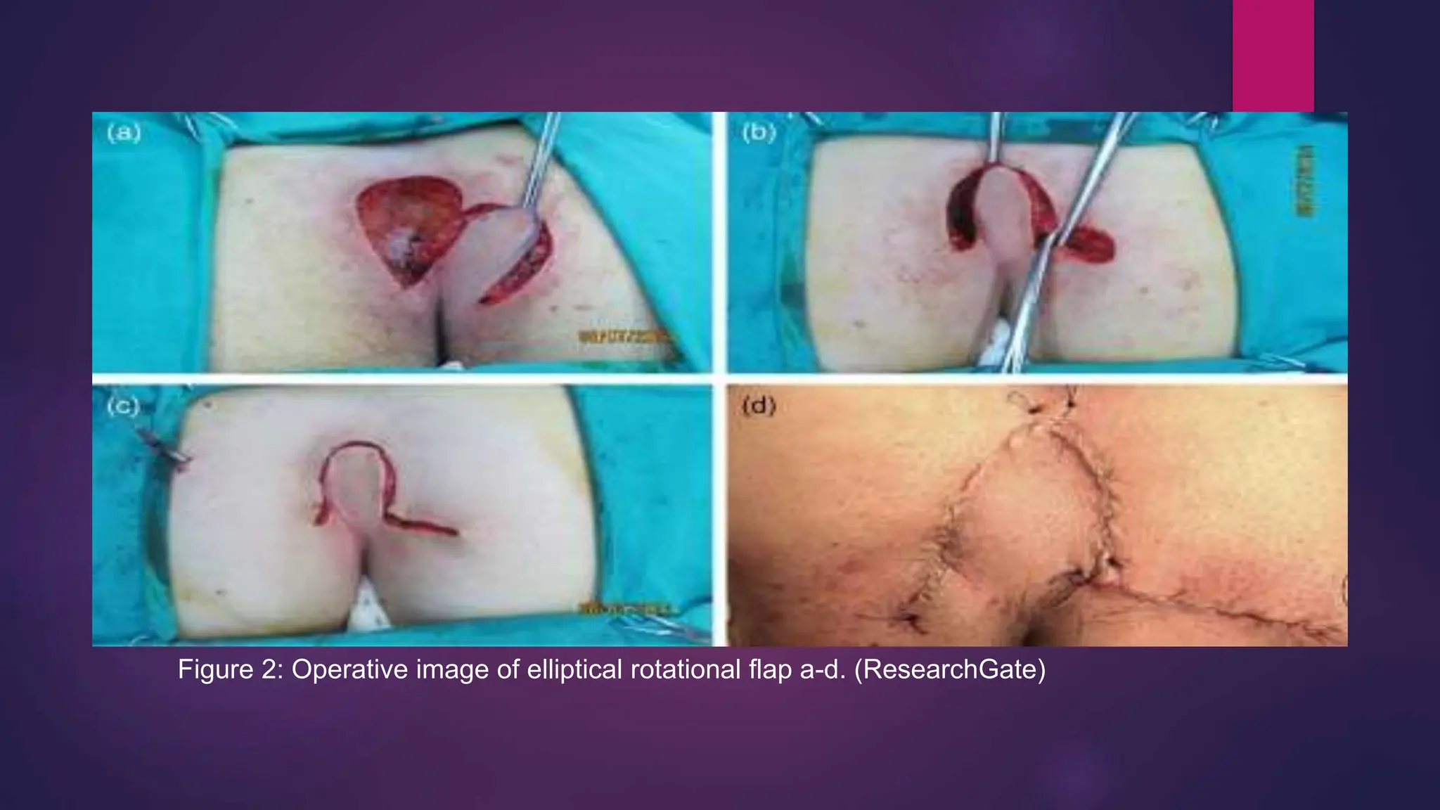 Figure 2: Operative image of elliptical rotational flap a-d. (ResearchGate)
 