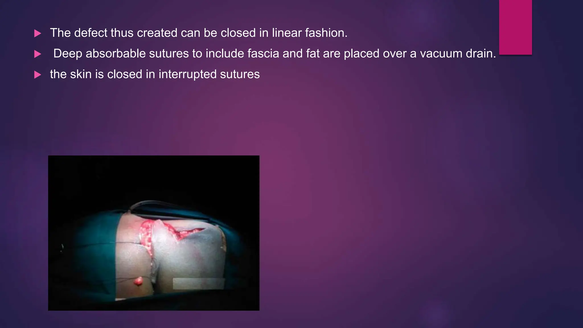  The defect thus created can be closed in linear fashion.
 Deep absorbable sutures to include fascia and fat are placed over a vacuum drain.
 the skin is closed in interrupted sutures
 