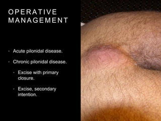 O P E R A T I V E
M A N A G E M E N T
• Acute pilonidal disease.
• Chronic pilonidal disease.
• Excise with primary
closure.
• Excise, secondary
intention.
 