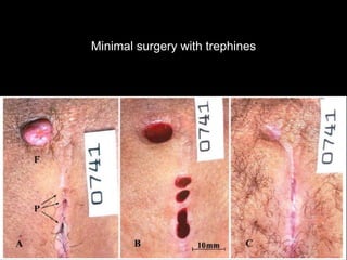 Minimal surgery with trephines
 