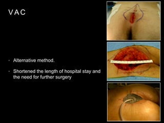 V A C
• Alternative method.
• Shortened the length of hospital stay and
the need for further surgery
 