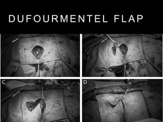 D U F O U R M E N T E L F L A P
 