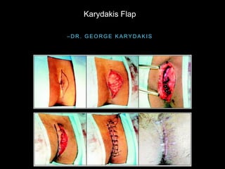 – D R . G E O R G E K A R Y D A K I S
Karydakis Flap
 