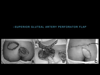 – S U P E R I O R G L U T E A L A R T E R Y P E R F O R A T O R F L A P
 