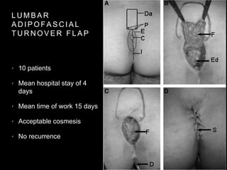 L U M B A R
A D I P O F A S C I A L
T U R N O V E R F L A P
• 10 patients
• Mean hospital stay of 4
days
• Mean time of work 15 days
• Acceptable cosmesis
• No recurrence
 