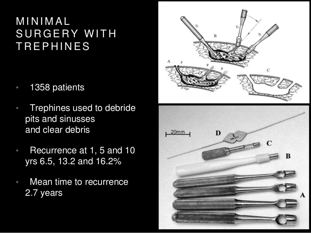 Pilonidal sinus defect closure, reconstruction methods